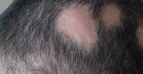 Alopecia Areata Cause E Possibili Rimedi Istituto Helvetico Sanders