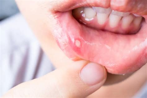 What Causes Mouth Ulcers How To Treat And Prevent Them Effectively