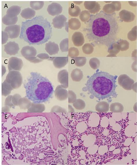 Bone Marrow Aspiration And Biopsy This Figure Depicts The Download Scientific Diagram