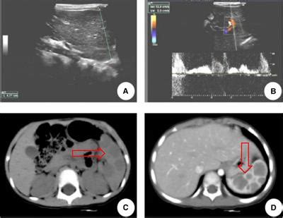 Frontiers Case Report And Literature Review Asymptomatic Littoral