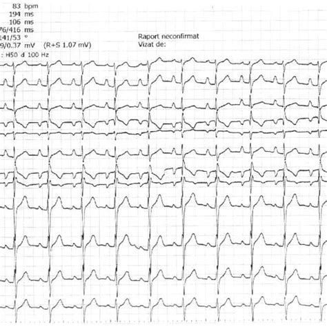 Twelve Lead Standard Electrocardiogram Normal Sinus Rhythm