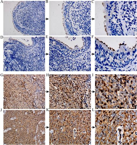 Bub1b Protein Expression In Non Tumor Nasopharynx And Npc Tissues