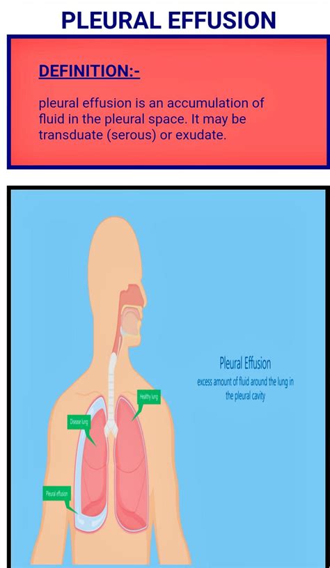 Solution Pleural Effusion Studypool