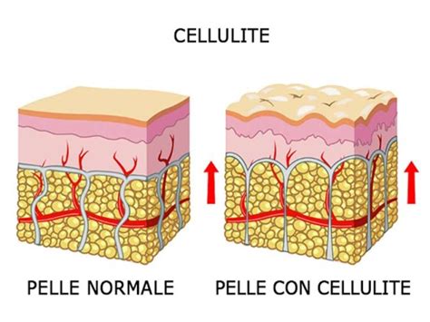 Eliminare la cellulite e la ritenzione idrica i rimedi più efficaci