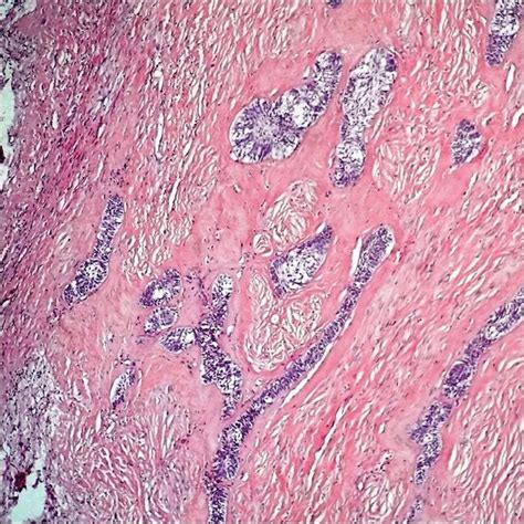 Islands Of Odontogenic Epithelium Exhibiting Peripheral Cells Arranged