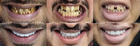 Composite Veneers Case Reviews - About Tooth Dental Clinic