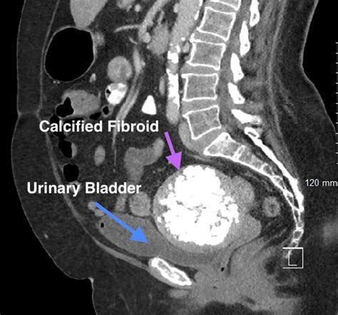 Effective Calcified Uterine Fibroid Treatment - Insights