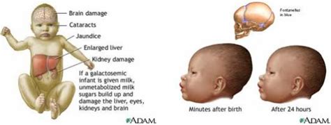 Phenylketonuria Disease