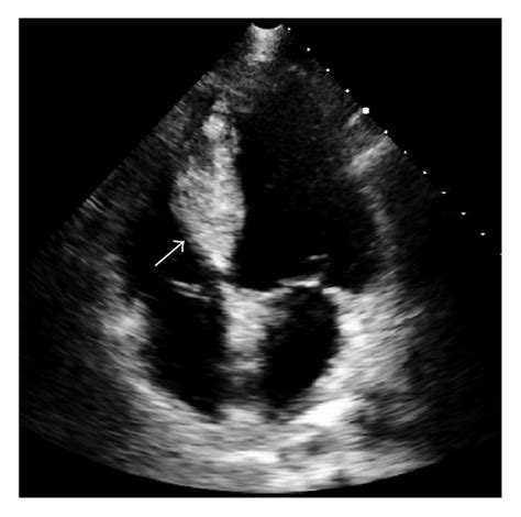 Interventricular Septal Hematoma 5 3 2 6 Cm Arrow A With