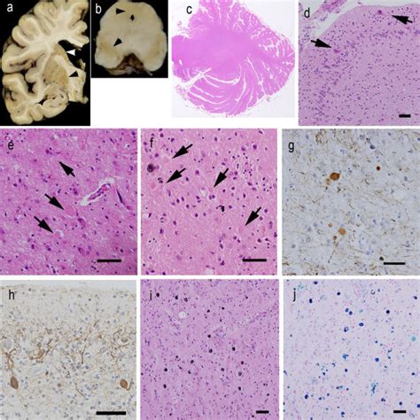 Summary Of The Neuropathological Findings In Autopsied Patients With