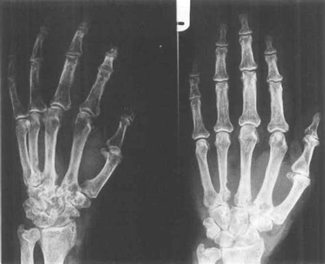 Extensive Erosion Of The Metacarpal Bones Carpal Bones And Distal Download Scientific Diagram