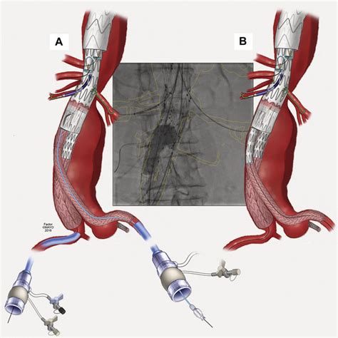 Pdf Technical Video Of Endovascular Repair Of Chronic Postdissection Thoracoabdominal Aortic