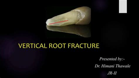 Vertical root fracture | PPT