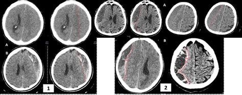 Caracterización tomográfica de las membranas en pacientes con hematoma