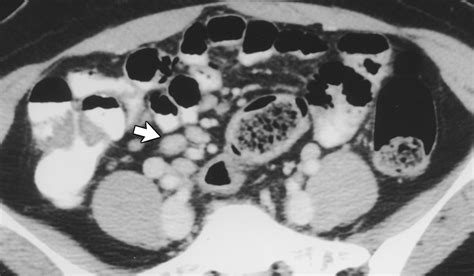 Mesenteric Adenitis Ct Diagnosis Of Primary Versus Secondary Causes Incidence And Clinical