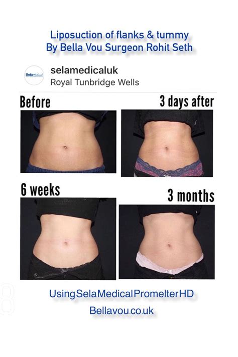 Before And After Liposuction By Bella Vou Is It Something Youre