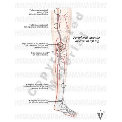 Distal Veins