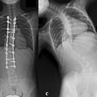 Radiographs Of A 15 Year Old Patient With AL Curve Preoperative