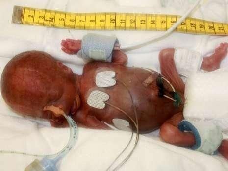 15 Best Micro preemie images | Micro preemie, Preemie, Nicu