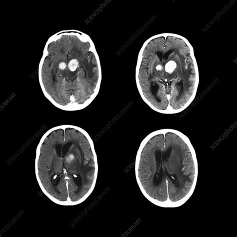 Brain Cancer Ct Scans Stock Image C0186989 Science Photo Library