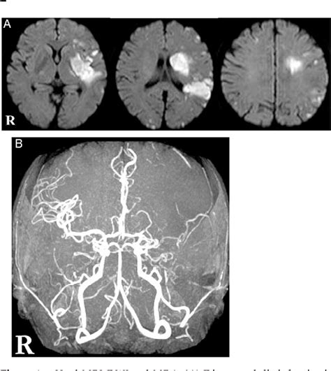 Figure From Nonbacterial Thrombotic Endocarditis Complicated By