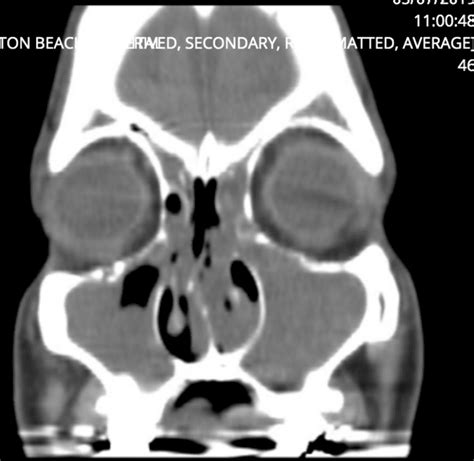 Chronic Sinusitis Nasal Polyps