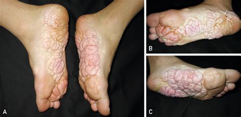 Cerebriform Plaques In Proteus Syndrome Mayo Clinic Proceedings