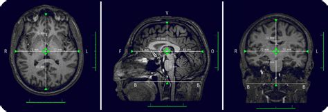 Atlas Jhp Mri Brain Atlas