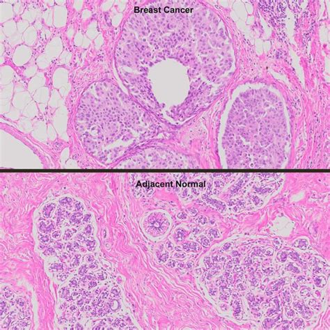 Human Breast Cancer With Erprher2 And Normal Matched Pair Tissue