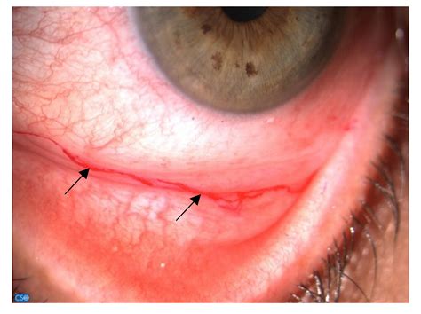 Jcm Free Full Text Sex Hormones Related Ocular Dryness In Breast Cancer Women