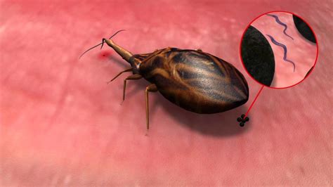 Chagas Symptoms Treatment Prevention Toronto Montreal Travel