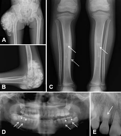 Hyperphosphatemic Familial Tumoral Calcinosis GeneReviews NCBI