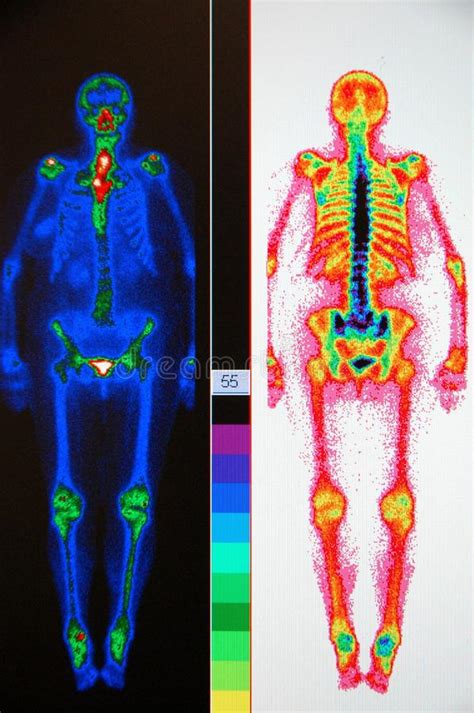 Stralingstherapie Voor Kanker Stock Foto Afbeelding Bestaande Uit