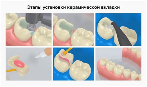 Цемент для восстановления культи зуба - фото