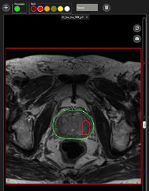 Prostate Mri Fusion Biopsy Procedure