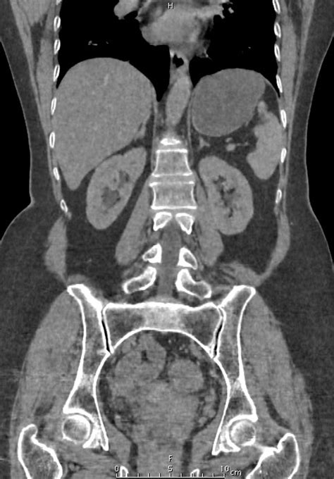 Virtual Precontrast Images Dual Energy Ct Sumer S Radiology Blog