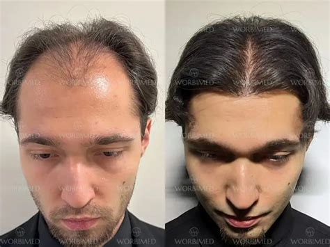 Hair Transplant In Istanbul Cost 2024