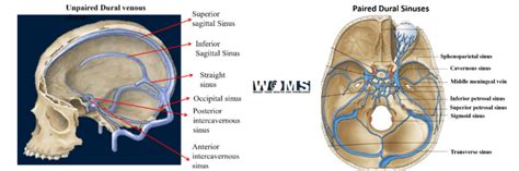 Normal as well as variant anatomy of the dural venous sinuses - WOMS