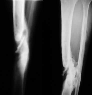 Chronic Osteomyelitis Imaging Practice Essentials Radiography