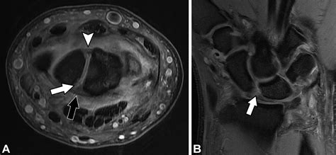 Scapholunate Ligament Mri