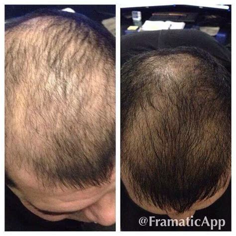 Before After Pics 2 Products Uses To Regrow Hair For Men Artofit