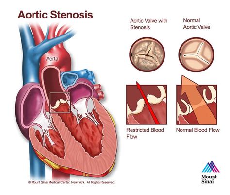 Aortic Stenosis The Mount Sinai Hospital Aortic Stenosis Heart Catheterization Stenosis