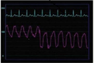 Hemodynamic Monitoring Flashcards Quizlet