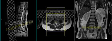 MRI whole spine | MRI whole spine protocol and planning