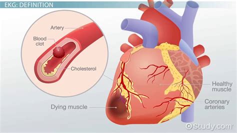 Ekg Heart Attack Reading