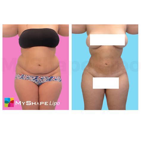 Blogs My Shape Lipo