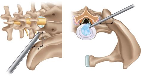 A Novel Preoperative Trajectory Evaluation Method For L5 S1