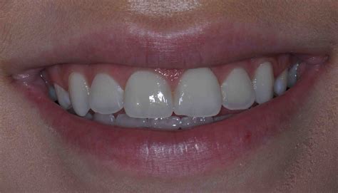 Professional Tooth Bleaching - Glendale AZ Dentist - Dr. Lee Ann Brady