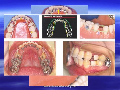 Lingual Orthodontics Certified Fixed Orthodontic Courses By Indian