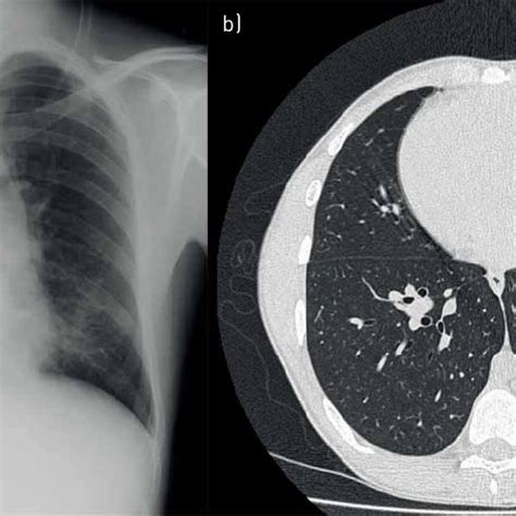 A Chest Radiograph Showing Dextrocardia B High Resolution Computed